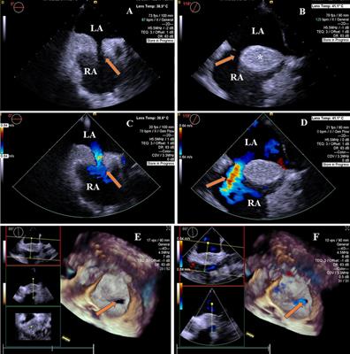 Multimodality imaging in diagnosing lipomatous atrial septal hypertrophy with atrial septal defect: a case report